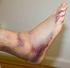 Lesões ligamentares do tornozelo Resumo de diretriz NHG M04 (segunda revisão,agosto 2012)