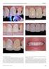 Visão 2. Protocolo Clínico para Confecção de Facetas Diretas em Resina Composta. Clinical protocol for fabrication of direct composite resin veneers