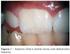 Dentes supranumerários retidos interferindo no tratamento ortodôntico