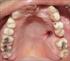 Treatment of Oroantral Fistula by Palatal Rotation Flap