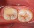 Infiltração marginal em cavidades classe v de dentes bovinos usando dois sistemas adesivos