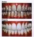 Clareamento Dentário como Etapa Prévia à Restauração de Dentes com Alteração Severa de Cor