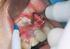 Cirurgia piezoelétrica em implantodontia: aplicações clínicas