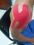 APLICAÇÃO DA KINESIO TAPING NA SUBLUXAÇÃO DE OMBRO EM PACIENTES PORTADORES DE ACIDENTE VASCULAR CEREBRAL CRÔNICO