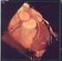 Reconstrução Tridimensional Dinâmica do Coração através da Ecocardiografia Transesofágica