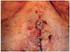 Plicatura da base umbilical: proposta técnica para tratar protrusões e evitar estigmas pós-abdominoplastia