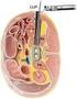 ANALYSIS OF INTERBODY VERSUS POSTEROLATERAL FUSION FOR LUMBAR SPONDYLOSIS