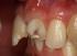 Reabilitação estético-funcional de fraturas coronárias em dentes decíduos