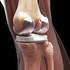 Total Knee Replacement