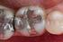 Utilização de matriz seccional e compósito SDR: como otimizar as restaurações em dentes posteriores