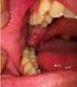 Dor Pós Operatória em Dentes com Infecções após Única ou Múltiplas Sessões Revisão Sistemática