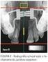 Ossificação da sutura palatina mediana após o procedimento de expansão rápida da maxila: estudo radiográfico