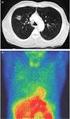 Original Article. Pulmonary tuberculosis: Tomographic evaluation in the active and post-treatment phases