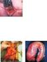 UNITERMOS: Nutrição. Cólon. Cirurgia. Anastomose intestinal.