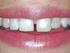 As resinas compostas como complemento à Ortodontia na obtenção de sorrisos naturais