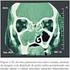 Mucormicose Rino-Órbito-Cerebral Associada com Trombose do Seio Cavernoso: Relato de Caso