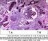 Múltiplas tromboses em um paciente com síndrome nefrótica. Case report of multiple thombosis in a patient with nephrotic syndrome