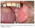 Cementoblastoma benigno na mandíbula: Relato de caso
