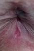 Associação de Lesões Anorretais em Portadoras de Infecção Genital por HPV e Neoplasia Cérvico-Uterina