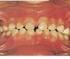 Osteogênese imperfeita associada à dentinogênese imperfeita: relato de caso