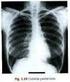 RADIOLOGIA PULMONAR INCIDÊNCIA : PÓSTERO-ANTERIOR (PA)