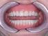 Satisfaction Level of Edentulous Patients Treated by Adamantina Dental School FAI