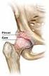 CONFLITO FEMORO-ACETABULAR