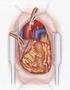REVASCULARIZAÇÃO ÓTIMA DO MIOCÁRDIO