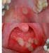 Aneurismas das artérias pulmonares na doença de Behçet: regressão após tratamento imunossupressor