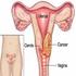 Câncer do colo uterino HPV FRR