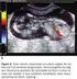 Dopplerfluxometria de Ducto Venoso - Identificação não Invasiva da Acidemia em Fetos Prematuros Centralizados