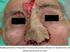Reconstrução cirúrgica com retalho pediculado de avanço após exérese de melanoma cutâneo facial em um cão - Relato de caso*