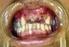 Infecção cervical grave de origem dentária: relato de caso