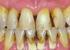 Avaliação do nível de informação sobre doenças periodontais dos pacientes em tratamento na Clínica de Periodontia da Univali