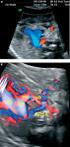 Pre Natal Diagnosis of Right Aortic Arch and Aberrant Left Subclavian Artery