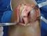 Instabilidade lateral da patela: tratamento cirúrgico combinado proximal via artroscópica e distal via aberta
