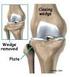 OSTEOTOMIA PROXIMAL DA TÍBIA: ESTABILIZAÇÃO DA ABERTURA MEDIAL COM ENXERTO TRICORTICAL DE ILÍACO