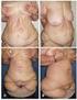 ABDOMINOPLASTIA: ESTUDO RETROSPECTIVO