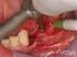 Reabilitação com implantes para mandíbula posterior atrófica: relato de caso clínico