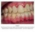 Avaliação da infiltração marginal após clareamento dental e restauração com resina composta, variando o sistema adesivo INTRODUÇÃO