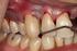 Os AA avaliam o efeito do tratamento periodontal sobre a diabetes melittus