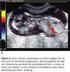 Valor preditivo do resultado fetal da dopplervelocimetria de ducto venoso entre a 11ª e a 14ª semanas de gestação