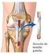 Reconstrução do ligamento cruzado anterior com enxerto de tendão patelar: avaliação pelo protocolo do IKDC *