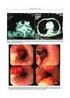 Carcinoma adenóide cístico laríngeo: A propósito de um caso clínico Adenoid cystic carcinoma of tha larynx: Case report