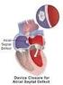 Percutaneous Closure of Ostium Secundum Atrial Septal Defect Using the Memopart Occlusion Device