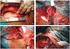 Rotura de aneurismas da aorta torácica: evidência para a endo-solução