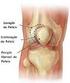 Luxação congênita do joelho: revisão crítica do tratamento cirúrgico
