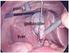 Gall Bladder Removal Surgery