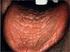 Introduction: Xerostomia, a subjective dry mouth feeling,