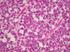Carcinoma de Pequenas Células Hipercalcêmico do Ovário